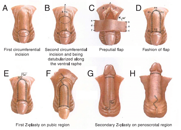 Penis Enhansment 6